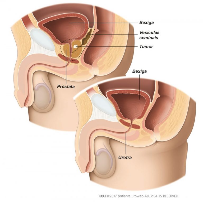 Câncer de Próstata e Impotência: a Ereção após a cirurgia